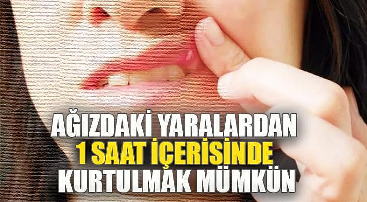 Ağızdaki yaralardan 1 saat içerisinde kurtulmak mümkün