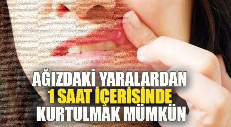 Ağızdaki yaralardan 1 saat içerisinde kurtulmak mümkün